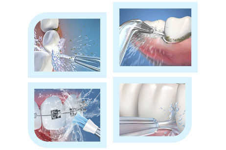 Diagram of the DentaStream water flosser cleaning between teeth, along the gumline, and around braces