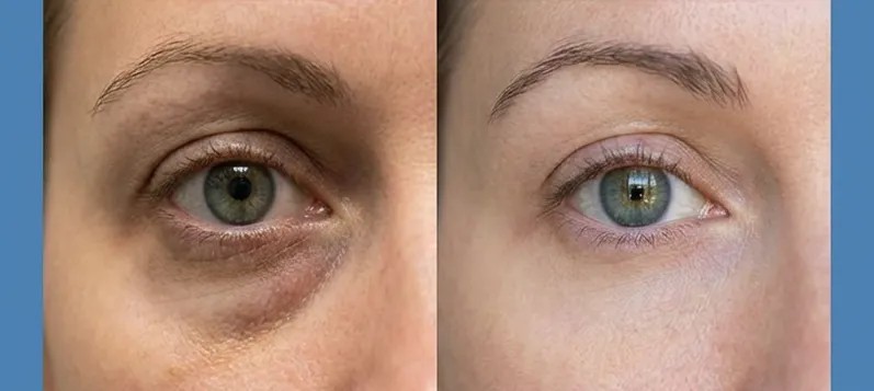 Side-by-side close-up of the same under-eye area, puffier with a darker shadow on the left and smoother on the right
