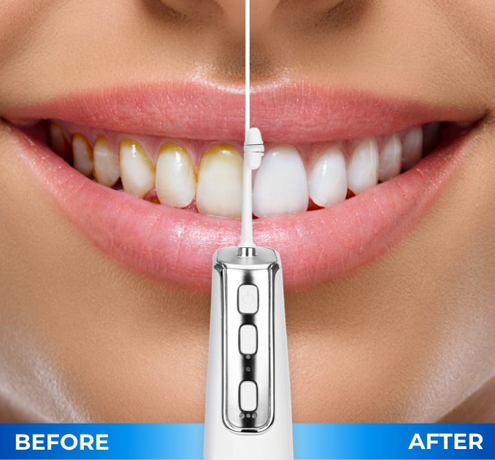 Before and after smile comparison with the Miracle Smile water flosser in front