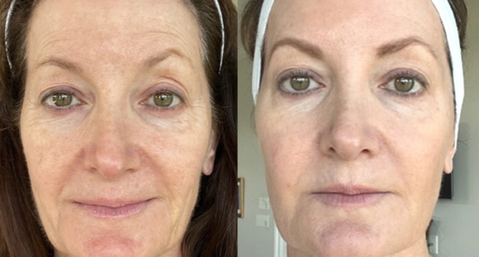 Before and after: a Total Package Serum customer with softer-looking lines around the eyes and mouth